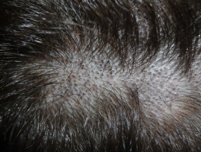 Грибок волосистой части головы