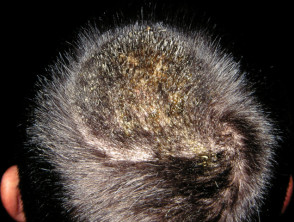 Грибок волосистой части головы