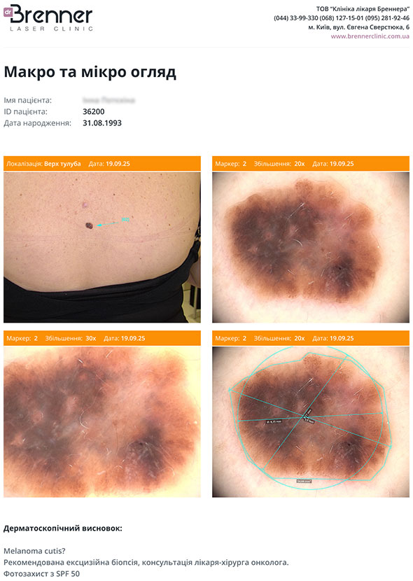 Цифровая дерматоскопия случайно обнаруженного подозрительного невуса